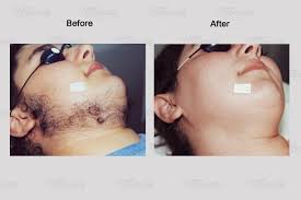 There are no knives, no needles, no anaesthesia and minimal recovery time. Laser Hair Removal Toronto Igbeauty Laser Skin Clinic