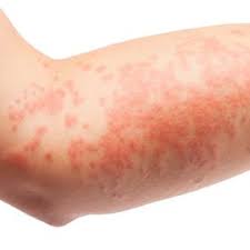 Pin On Hiv