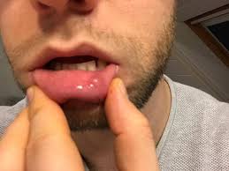 Hinter schmerzhaften knoten am after kann eine analthrombose stecken. Knubbel Die Meistgelesenen Fragen