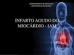Diagnóstico do infarto agudo do miocárdio. Infarto Agudo Do Miocardio