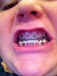 Just follow the following steps. How To Make Fake Braces Thes Are Real Braces Get A Paper Clip Beads Stick The Beads Though The P Fake Braces How To Make Fake Braces Fake Braces That Look
