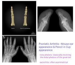Psoriatic Arthritis Pencil In Cup Appearance Mouse Ear Peripheral Erosion Note Gull Wing Peripheral Erosion I Psoriatic Arthritis Psoriatic Arthritis