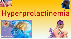 Image result for Hyperprolactinemia
