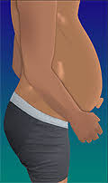 The prognosis the life expectancy depends on the cause of ascities. Ascites Fluid In The Belly Viral Hepatitis And Liver Disease