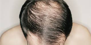 Rambut tebal menandakan bahwa rambut kamu sehat. Inilah 8 Petua Lebatkan Rambut Nipis Dan Mencegah Keguguran Rambut Kartel Dakwah