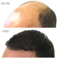 Find opening hours and closing hours from the transplant surgeons category in los angeles, ca and other contact details such as address, phone number, website. Best Hair Transplant In Los Angeles Ca Revive Hair Restoration By Best Hair Transplant Los Angeles Medium