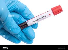 Image result for Herpes Simplex Virus Testing