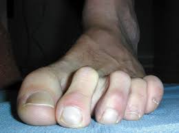 Curly Toes Prairie Path Foot Ankle Clinic Foot Problem Orthoses Feet Care