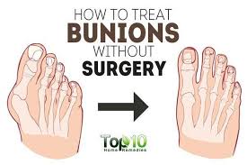 How To Treat Bunions Without Surgery Top 10 Home Remedies How To Treat Bunions Bunion Treatment Foot Remedies