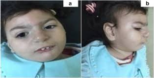 Cytogenomic characterization of 1q43q44 deletion associated with  4q32.1q35.2 duplication and phenotype correlation