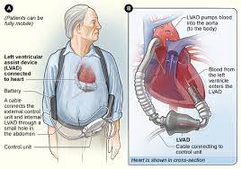 A vad can keep blood pumping despite a diseased heart and will be removed when your new heart is implanted. Department Of Surgery Ventricular Assist Devices Vad