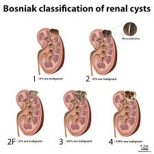 diagram bosniak classification of renal cysts radiology