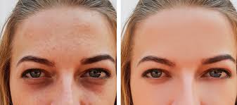 Causes Of Dark Circles And Treatments Bakersfield Medspa Blog