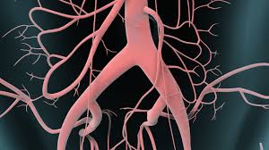 Sintomi tosse, raucedine, difficoltà a respirare e a deglutire, dolore retrosternale sono sintomi dell'aneurisma toracico o aortico. Aneurisma Aortico Abdominal Youtube