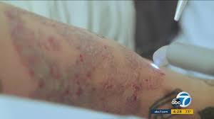 It's often larger than the wound itself, because the cells that are supposed to fix the problem keep building scar tissue even after the wound heals. Tattoo Laser Removal What You Need To Know Abc7 Los Angeles