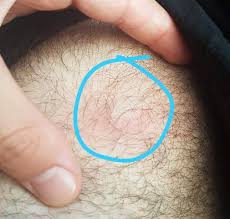 Das dampfbad kann mit kamillenblüten durchgeführt werden oder auch mit anderen desinfizierend zutaten. Pickel Unter Haut Am Bein Gesundheit Und Medizin Beauty Gesicht