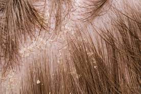 Soon, little sores were popping up and between the sores and itching, my hair started falling out. Dandruff And Hair Loss Causes And Treatments Hairguard