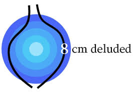 8 Centimeters Deluded My Cousins Fab Cervical Dilation Chart