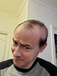 Steve Schulz: "Welp! Goodbye, hair! #Radiati…"