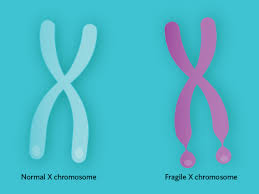 Recent Trials For Fragile X Syndrome Offer Hope The Scientist Magazine