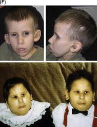 Signs and symptoms include an unusually shaped skull. Hallermann Streiff Syndrome An Overview Sciencedirect Topics