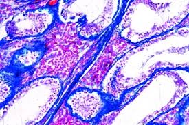 Vishwanathan a.n., beriwal s., de los santos j.f. Mikropraparat Karzinom Am Hals Der Gebarmutter Carcinoma Cervicis Uteri