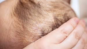 Image result for dry scabs on the head in children