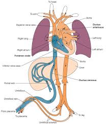 Image result for Delayed Transition from Fetal Circulation