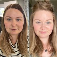 Gluten free for one week and my skin has completely changed, under eye  circles almost completely gone! Is this normal? I'm shocked and so happy!  No makeup/filter : r/glutenfree