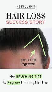 Brushing Tips For Receding Hairline To Regrow Hair Regrow Hair Help Hair Loss Hair Loss