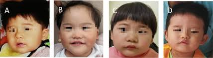 A genotypic and phenotypic analysis of four unrelated Chinese patients with  Pitt–Hopkins syndrome