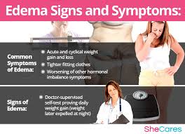 Image result for Edema Exam