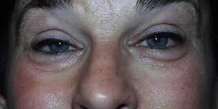 7:06 keddr.com recommended for you. What Is Ptosis American Academy Of Ophthalmology