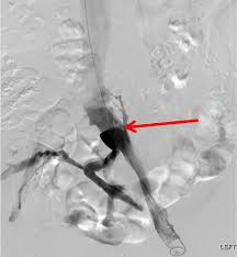 May Thurner Syndrome From Spinal Anterolisthesis Journal Of Minimally Invasive Gynecology