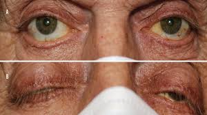 Image result for Eyelid Closure Defect
