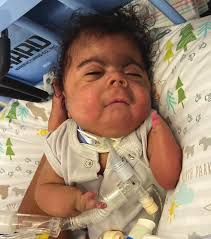 COVID-19 Vaccine and Individuals with CdLS Palliative Care Benefits