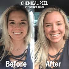 Solution For Better Skin My Chemical Peel Experience Chemical Peel Facial Peel Skin Peeling On Face
