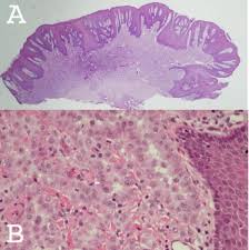 This is the newest place to search, delivering top results from across the web. Oral Presentation Of Malignant Mesothelioma Oral Surgery Oral Medicine Oral Pathology Oral Radiology And Endodontics
