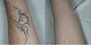 We did not find results for: Laser Tattoo Removal Results And Issues The Pmfa Journal