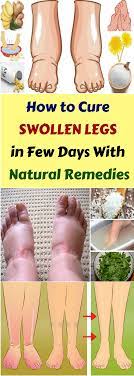 Swelling Of Feet And Ankle Is Experienced By Many Of Us Pregnant Women Are The Most Likely To Suffer From It The Swollen Legs Foot Remedies Natural Remedies