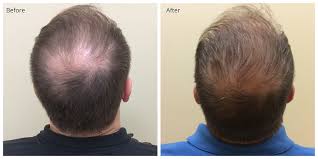 Heres our review on the 20 best hair growth and regrowth products proven to work for men and women. Hair Restoration In Morganotwn Wv And Surrounding Areas Your Dream Body