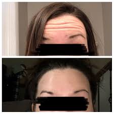 4) the route in which they took opiates, i.e. 5 Days After Dysport Newbie To Botox Dysport Wasn T Sure What To Expect But I M Happy With The Results Note Uneven Brows And Shape Are Due To The Over Plucking Craze In The Early