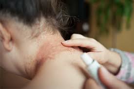 The medicines in this family differ primarily by the strength of each compound. Is Topical Steroid Withdrawal Real Eczema Life