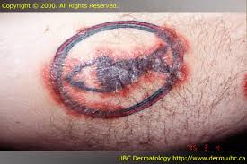 Image result for koebner phenomenon psoriasis
