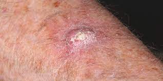 In the united states, it's estimated that doctors diagnose over 100,000 new skin cancer cases each year. Scc Keratoacanthoma Type Skin Cancer And Reconstructive Surgery Center