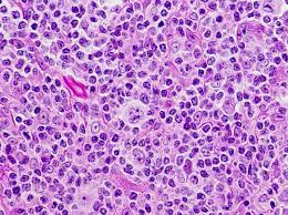 Pathology Outlines Nodular Lymphocyte Predominant
