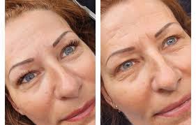 Hello Everyone. I am a beginner lash technician. Did 10 models so far.  Would like to share my recent 2 sets with you. What do you think?