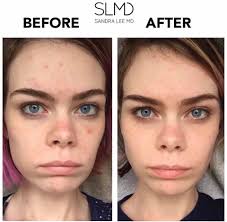Age is but a number 🔢 It's never too early or late to treat your acne!! ✨  This is what @chelseabcollum has to say about her SLMD experience thus far  📢 "I've