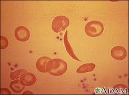 Image result for Peripheral Smear