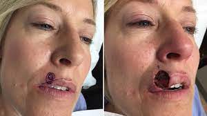 02.07.2018 · basal cell carcinoma is the most common form of skin cancer, according to the skin cancer foundation. Woman Mistakes Skin Cancer On Lip For Pimple